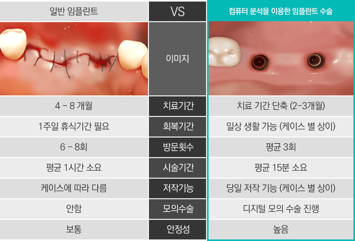 일반 임플란트 vs 네비게이션 임플란트